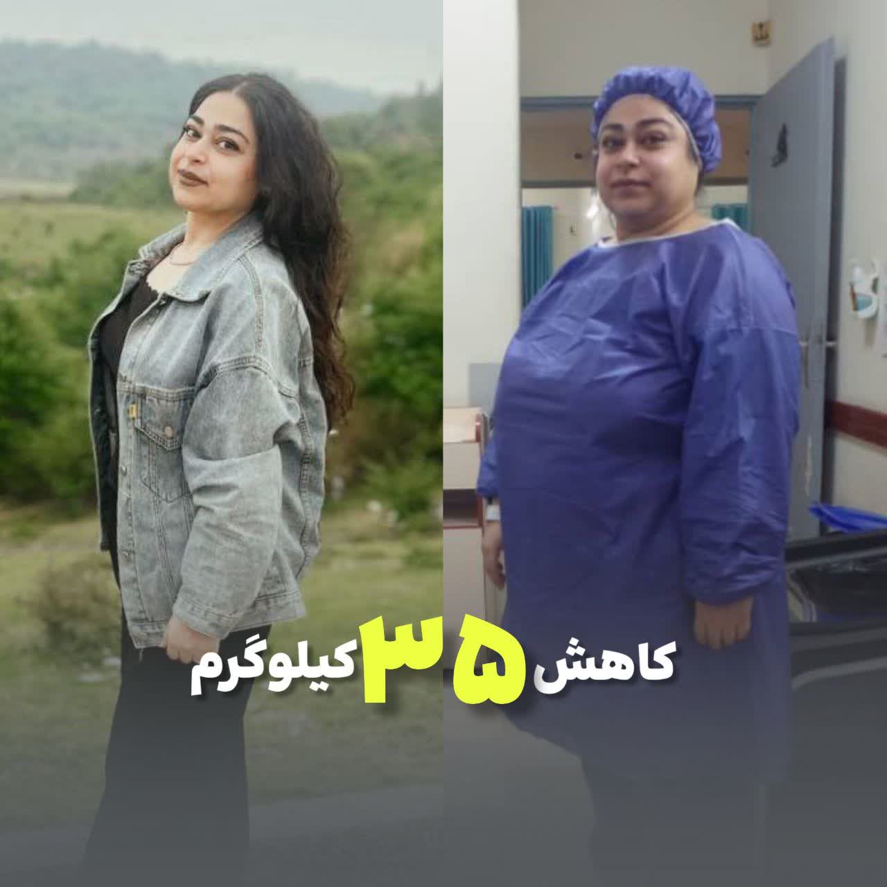 وزن اولیه 108 وزن بعدی 73 . 4 ماه بعد اسلیو